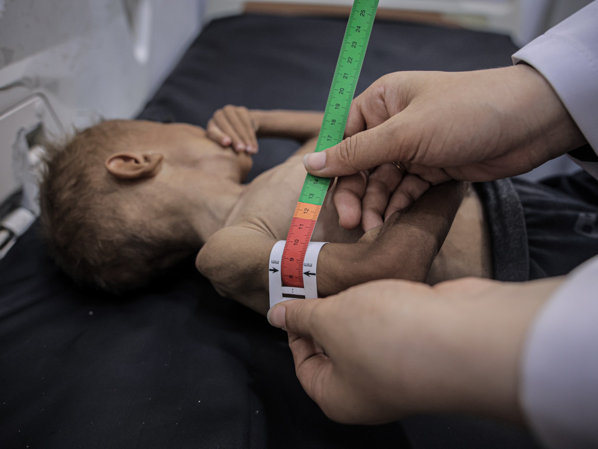 AA 20250729 38698981 38698968 DOCTOR REFUTES ISRAELI CLAIMS AS STARVING PALESTINIAN BABY BECOMES SYM