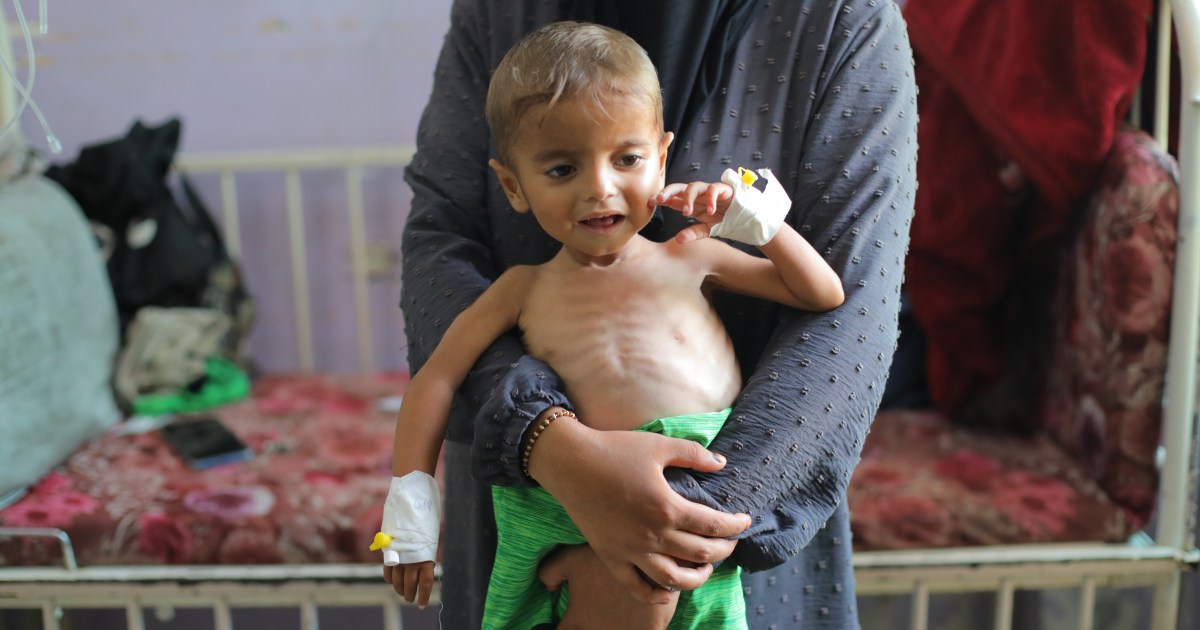 AA 20250813 38815916 38815902 MALNOURISHED GAZA CHILDREN TREATED WITH LIMITED MEDICAL RESOURCES 1755